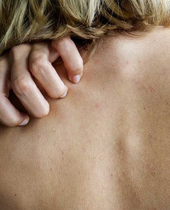 Miért gyakoribb a bőrallergia változókor során és hogyan enyhítők a tünetek?