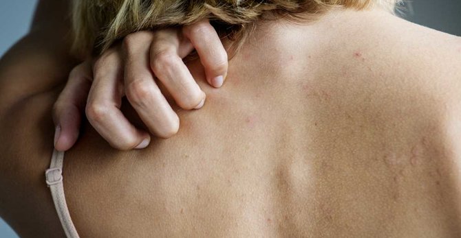 Miért gyakoribb a bőrallergia változókor során és hogyan enyhítők a tünetek?